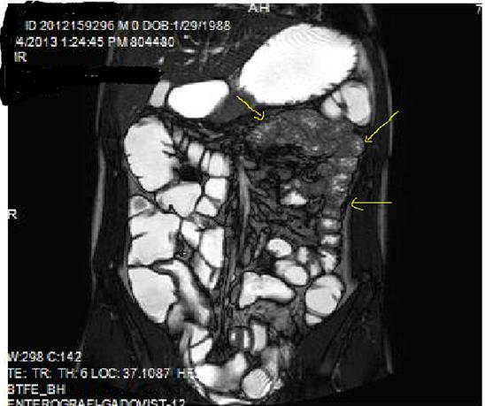 Diffuse mucosal involvement and increased wall thickness with loss of valvula conniventes in the ileal segments on T2W coronal images after OCA administration, seen on 30 years old female with moderate Crohn’s disease.