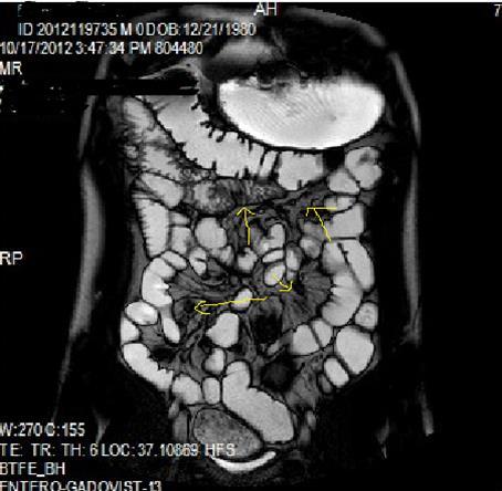 Mucosal involvement and lack of opacified ileal segments with loss of intestinal folds and increased bowel wall thickness due to Crohn’s disease on T2W coronal sequence after OCA, presented at 37 years old male with moderate Crohn’s disease.