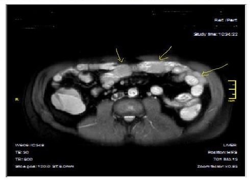 Mucosal, luminal and bowel wall involvement in Crohn’s disease with skipped lesions, seen at T2W axial image after OCA, presented at 45 years old male with severe inflammatory disease.