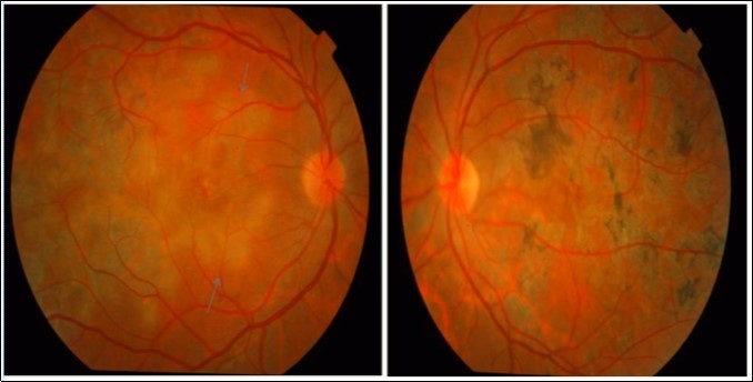 Color photograph of the right eye of patient 1shows an active MSC (blue arrows) and left eye shows healed MSC from her initial visit