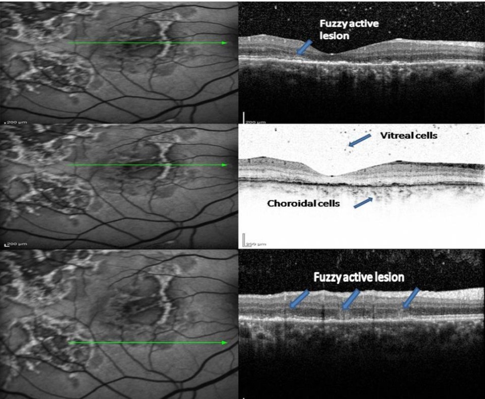 FAF (left) and corresponding eye-tracked SD-OCT image (right) of patient 1 an acute stage of the right eye shows fuzzy area of hyperreflectivity in the outer retinal layers involving the RPE, photoreceptor outer segment tips (POST), photoreceptor inner segment–outer segment (IS/OS) junction, external limiting membrane (ELM), and the outer nuclear layer (ONL) with vitreal and choroidal cells