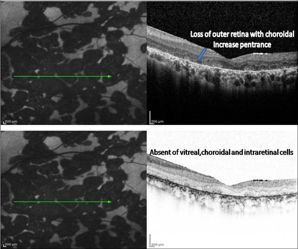 FAF (left) and corresponding eye-tracked SD-OCT image (right) of patient 1 healed stage of the left eye shows showed loss of RPE, POST, IS/OS junction, and ELM with increased reflectance from the choroidal layers. absent of the choroidal and intraretinal cells.