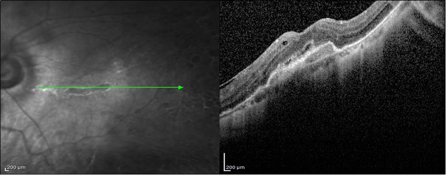 3 years Post-SOR SD-OCT image of a 44-year-old patient with BCVA 6/36 after anatomical repair of a macula-on GRT with encilrclage PPV + SOI with preoperative BCVA 6/6. We can notice the presence of SRNVM, IS/OS (ellipsoid zone) disruption, and RPE changes.
