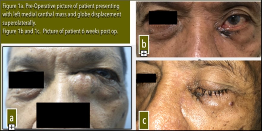 Pre-Operative picture of patient presenting with left medial canthal mass and globe displacement superolaterally. Figure 1b and 1c. Picture of patient 6 weeks post op.