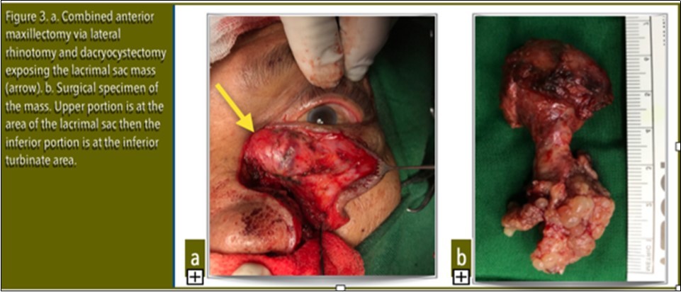 a. Combined anterior maxillectomy via lateral rhinotomy and dacryocystectomy exposing the lacrimal sac mass (arrow). b. Surgical specimen of the mass. Upper portion is at the area of the lacrimal sac then the inferior portion is at the inferior turbinate area.