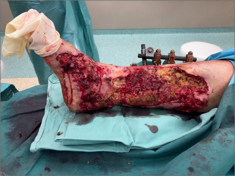 19 February. performed necrectomy, vitalization of subcutis, application negative pressure wound therapy