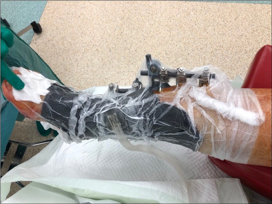 19 February. application of negative pressure wound therapy Vivano. application of polyurethane foam, foil, central port with tubing