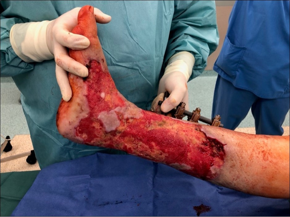 19 March. Defect of limb already clean with granulation ready for application of dermoepidermal graft