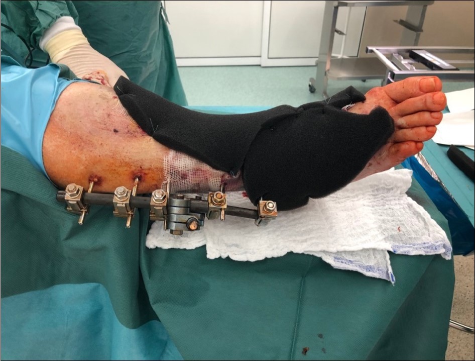 application of dermoepidermal graft with vacuum therapy of 90mmHg