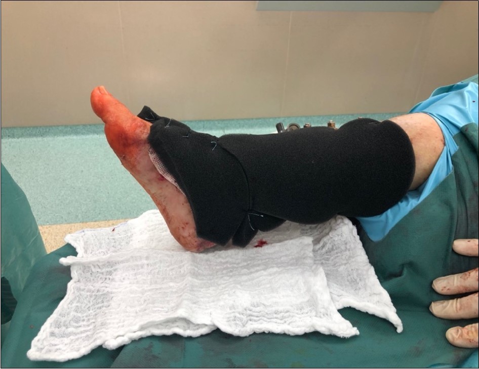 application of dermoepidermal graft with vacuum therapy of 90mmHg