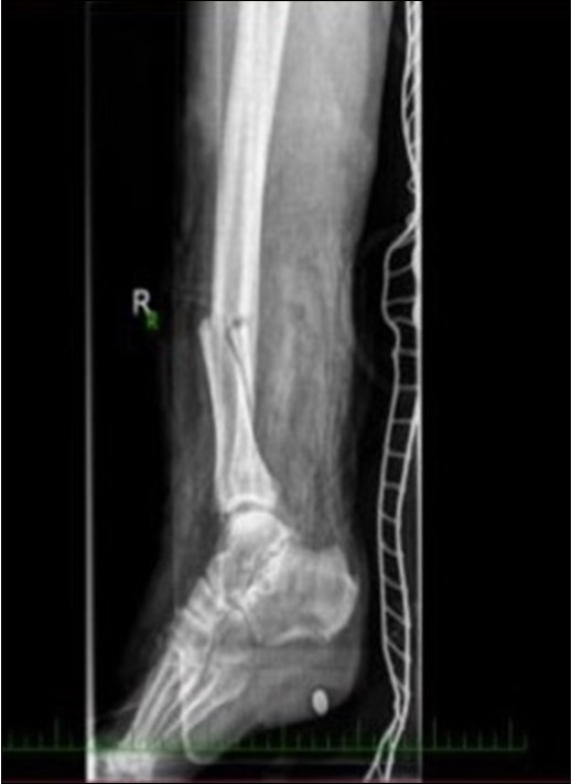 22 January – primary X-ray oblique splinter fracture of the tibia shaft