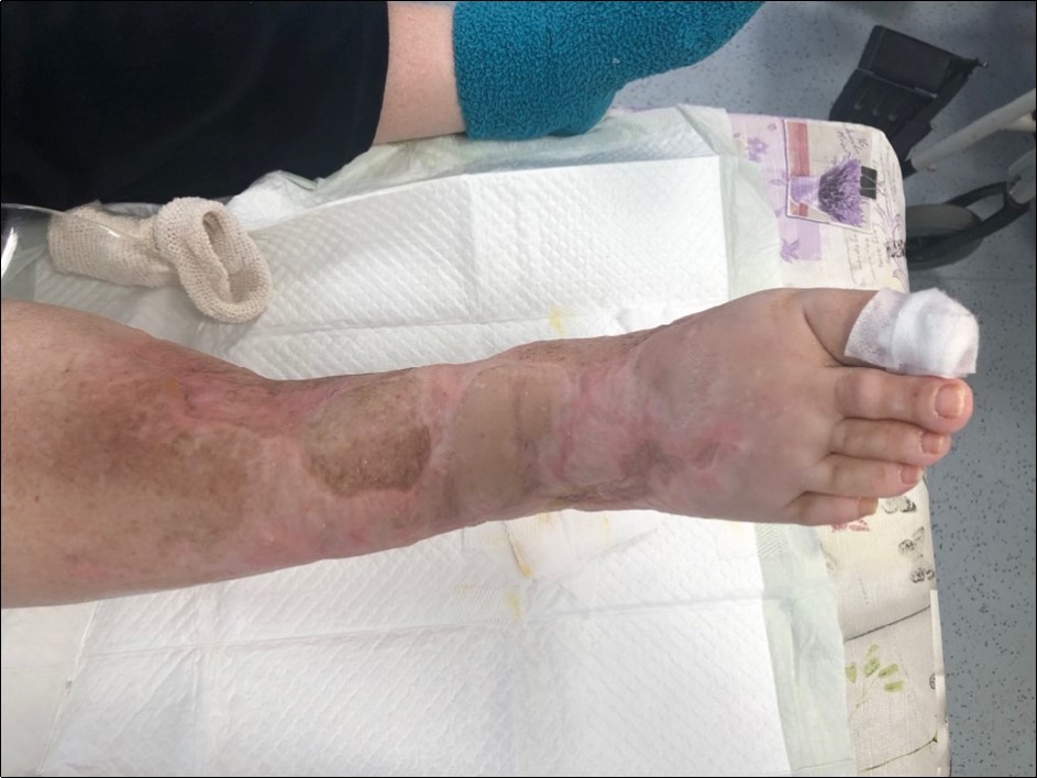 October 2019. skin cover completely healed. 8 months from the injury to heal soft tissues