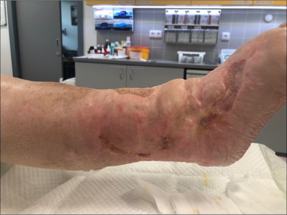 October 2019. skin cover completely healed. 8 months from the injury to heal soft tissues