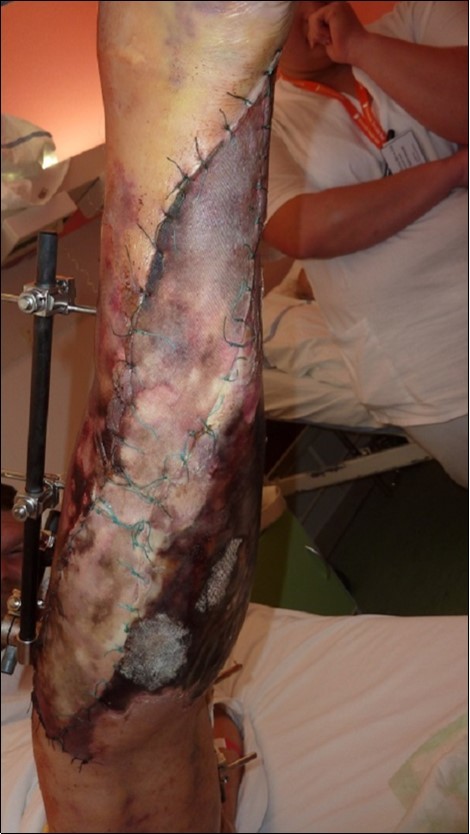 After 2 weeks. Progression of the skin necrosis line demarcation