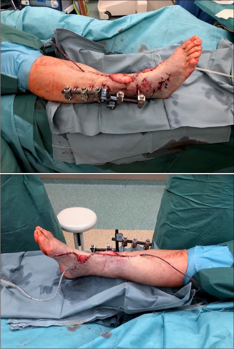Debriteman and removal of macroscopic impurities Fracture stabilization using external fixator Reconstruction of soft tissue, subcutis and skin, necrectomy Installation of flushing lavage Covering defects with artificial skin – Syncryt