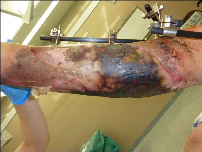 After 2 weeks. Progression of the skin necrosis line demarcation