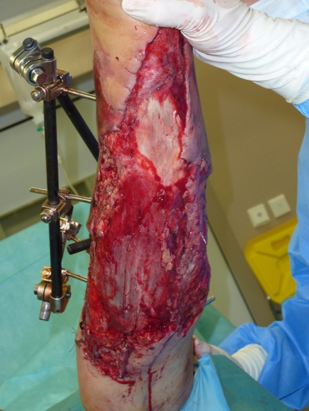 Picture of dressing changing of negative pressure woud therapy after 5weeks. demonstration of subcutaneous granulation. wound dressing changing every 5-6 days