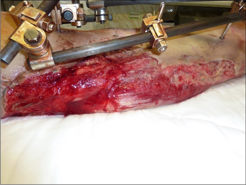 Dressing changing negative pressure woud therapy after 5 weeks. demonstration of subcutaneous granulation. wound dressing changing every 5-6 days