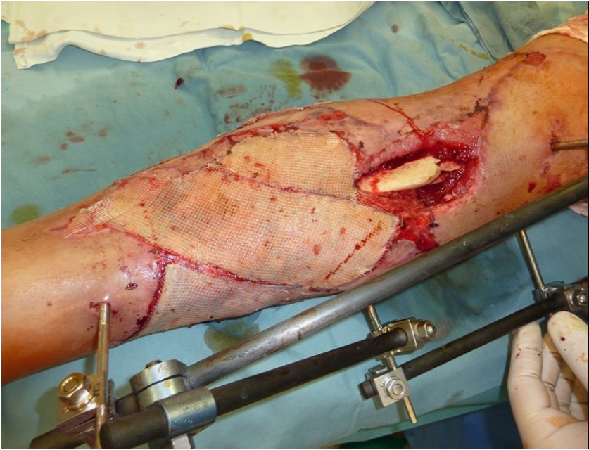 Application of dermoepidermal graft in individual steps from December 2015 to January 2016. use of vacuum therapy with good graft fixation and graft drainage