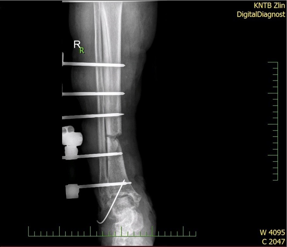 22 January – primary X-ray - Fracture stabilization using external fixator
