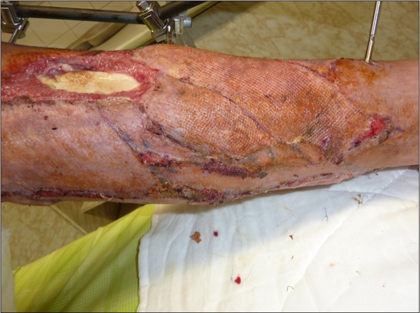 January 2016. resection of the tibial avital cortica and resuture