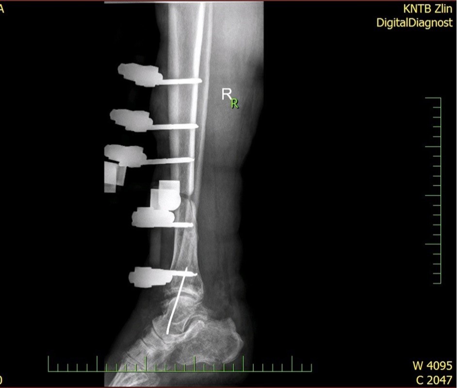 22 January – primary X-ray - Fracture stabilization using external fixator