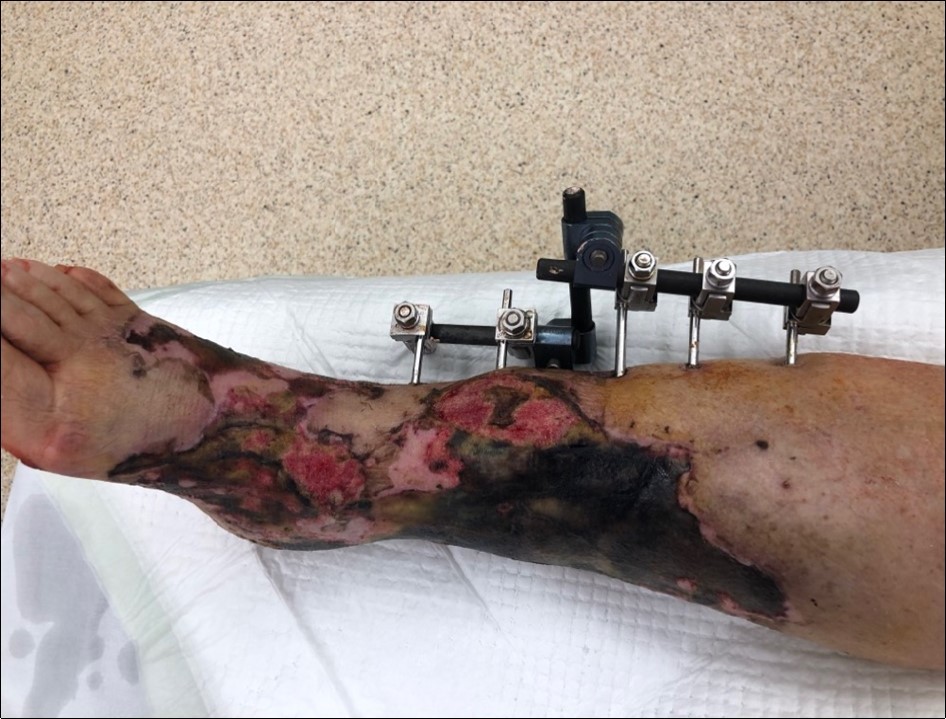 9 February. Extensive necrosis of skin and subcutis in the area of primary limb laceration. Progression of the skin necrosis line demarcation