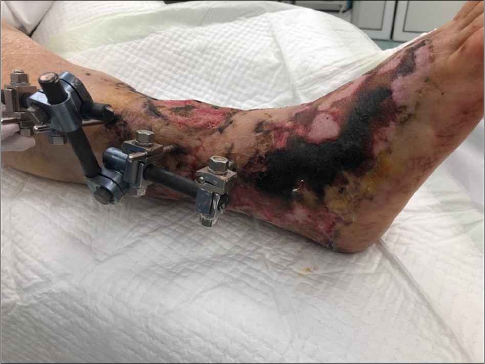 9 February. Extensive necrosis of skin and subcutis in the area of primary limb laceration. Progression of the skin necrosis line demarcation