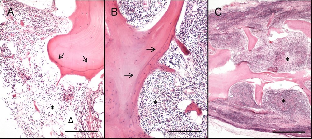 Histological evaluation of WM bone biopsies 3 (A), 4 (B) and 8 (C) months post implantation. Specimens collected three months after implantation (A) present infiltration of malignant cells, as well as adipocytes, while bone trabeculae appear thinned; H&E; Scale bar: 0.2mm. Four months after surgery (B), specimens present also thinned bone trabeculae and bone marrow infiltration by WM cells; H&E; Scale bar: 0.2mm. Biopsies extracted 8 months post implantation (C) also present resorptive lesions and high-grade infiltration by malignant cells; H&E; Scale bar: 0.5mm. Cellularity due to malignancy is labelled with asterisks, adipocytes with triangles, and cement line with arrows.