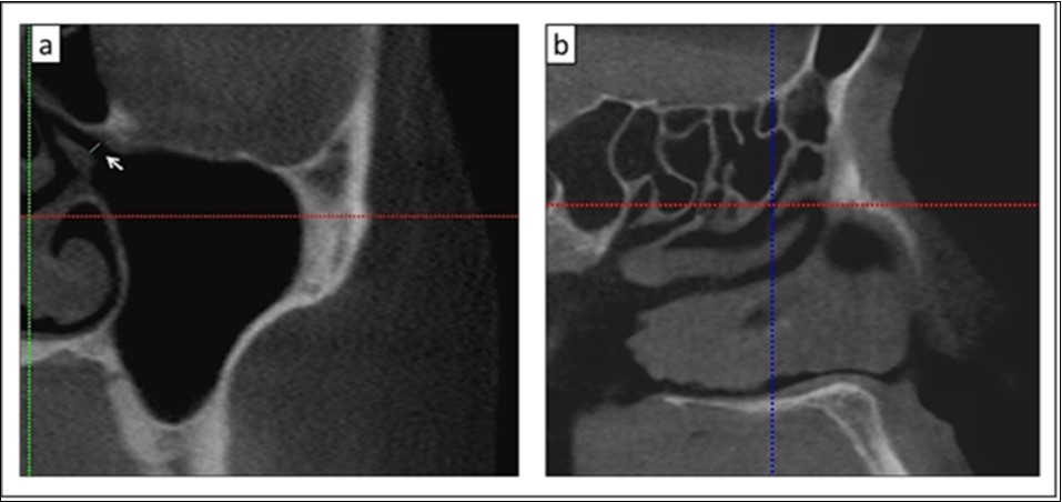 a) Measurement of the primary maxillary ostium between the lower bony part of ethmoid and the uncinate process (white arrow); b) Location of the primary maxillary ostium in the coronal section (a) which is observed in the sagittal section (crosshair lines)