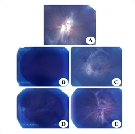 NBT reduction in the eye lens of from different experimental group animals to assay for superoxide anion generation. Blue colour formation upon incubation with 0.3% NBT for observed after 45 min with intense blue colour formation indicative of superoxide anion generation. Inset (A): Physiological saline treated (group I); (B) Selenite treated (group II); (C) Selenium and resveratrol administered simultaneously (group III); (D) Resveratrol administered 24 h after treatment with selenite (group IV); (E) Resveratrol administered 24 h before treatment with selenite (group V).