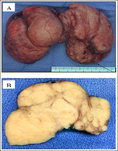 Gross examination of the thyroidectomy specimen shows a diffusely enlarged thyroid gland with bilateral bulging nodules (A, picture taken before fixation). A cut section shows the thyroid gland is replaced by innumerable yellow tan solid nodules of variable sizes surrounded by fibrous bands (B, picture taken after fixation).