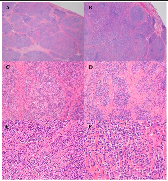 Representative photomicrographs of the thyroidectomy specimen. Scanning power view shows many nodules separated by fibrous bands (A). There were a few scattered small foci of lymphocytic infiltrate with lymphoid follicle and germinal center formation, suggestive of Hashimoto’s thyroiditis (B). Low to medium power view showing a dense plasmacytic infiltrate with remnant atrophic thyroid follicles visible in some nodules (C), while in other nodules the thyroid parenchyma is almost entirely replaced by sheets of plasma cells (D, E). At high power, the plasma cells are well–differentiated; they have eccentrically-located nuclei, clock-face chromatin, inconspicuous nucleoli, and abundant cytoplasm (F). (H&E stain; original magnification, x 10 A, x 20 B, x 100 C and D, x 200 E, and x 400 F).