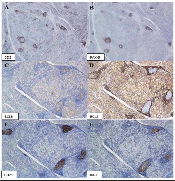 Immunohistochemical stains show the lymphocytes are predominantly T-cells (CD3 positive, A), with the lymphoid follicles highlighted by PAX-5 stain (B). The germinal centers are positive for BCL6 (C) and negative for BCL2 (D). CD21 stain highlights undisrupted follicular dendritic cell meshworks (E). Ki67 stain shows appropriately high proliferation rates in germinal centers with polarization. (Immunoperoxidase staining; original magnification, x 20 A and B, x 40 C).