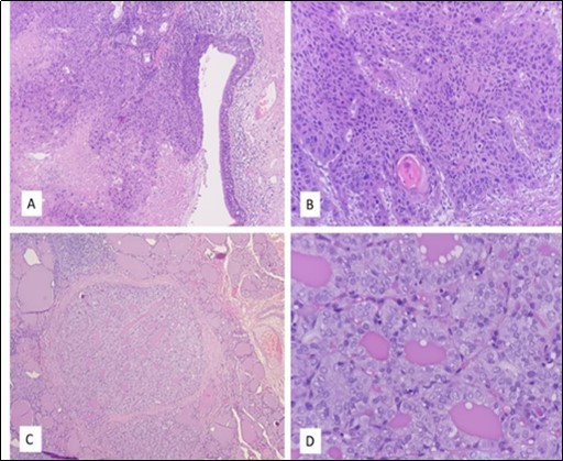 A: Larynx: Full thickness dysplasia of the lining epithelium of the false vocal cord followed by invasion into the stroma with necrotic area. (H&E x40). B: Larynx: The tumour arranged in nest with moderately pleomorphic nuclei. Intercellular bridging, keratin pearl and mitoses are observed. (H&E x100). C: Thyroid: One of the foci of papillary micro carcinoma, surrounded by benign thyroid follicle. (H&E x40). D: Thyroid: The tumor cells showed enlarged, elongated and overlapping nuclei, irregular nuclear membrane, nuclear grooving and Orphan Annie nuclei (H&E x400)