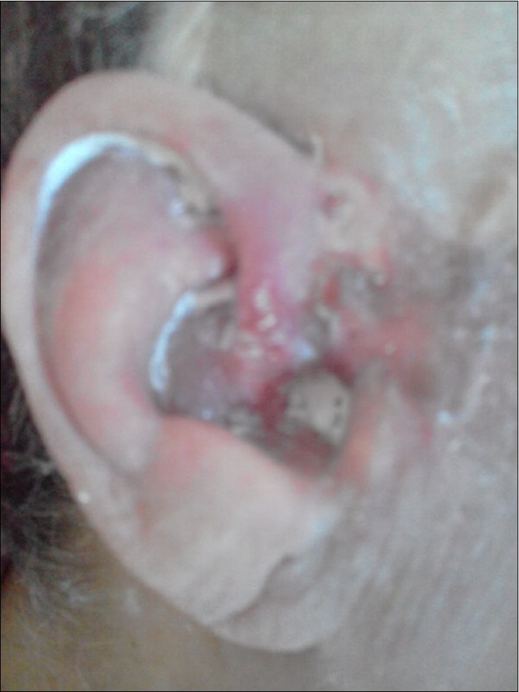 Right ear; Basal Cell Carcinoma (BCC) seen in the skin of ear and adjacent areas, removal of cancer cells after Bee Venom subcutaneous injection.