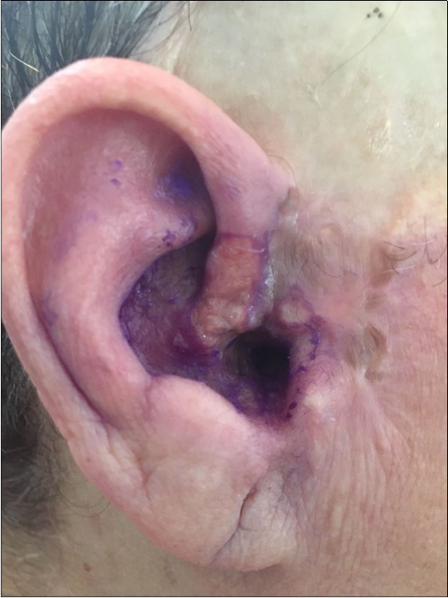 Right ear; Basal Cell Carcinoma (BCC) seen in the skin of ear and adjacent areas, removal of cancer cells after Bee Venom subcutaneous injection.