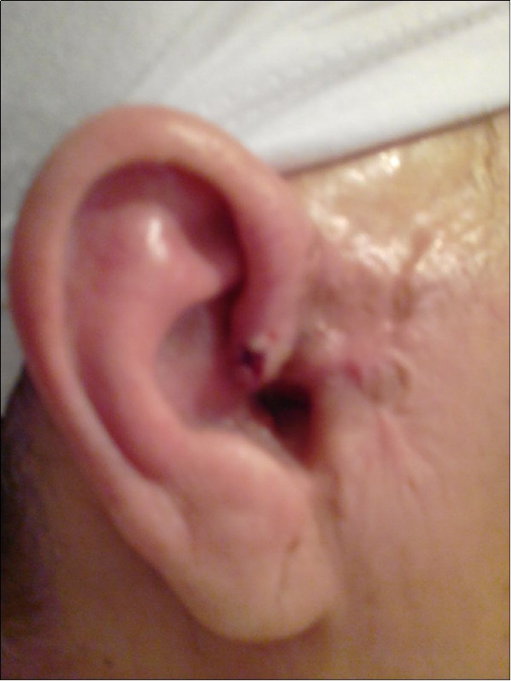 Right ear; complete recovery of Basal Cell Carcinoma (BCC) seen in the skin of ear and adjacent areas, removal of cancer cells after Bee Venom subcutaneous injection.