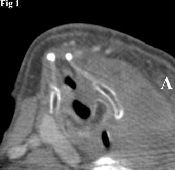 CT image of left thyroid lobe tumor causing rightward displacement of the laryngeal structures. The mass has a homogeneous appearance.