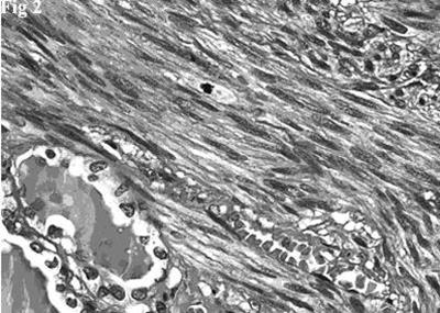 Hematoxylin and eosin stain showing a fascicle of spindle cells contiguous to residual thyroid follicles. The spindle cells posses blunt-ended, moderately hyperchromatic nuclei. A mitotic figure is evident (top, center).