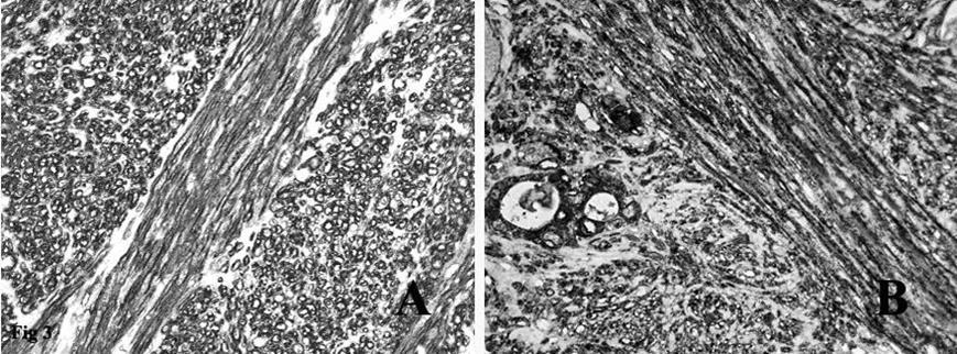 A. Immunohistochemical stain on the fascicles of tumor cells intersecting each other at right angles was strongly positive for smooth muscle actin. B. Immunohistochemical stain on the spindle tumor cells and on the residual thyroid follicles was positive for EMA.