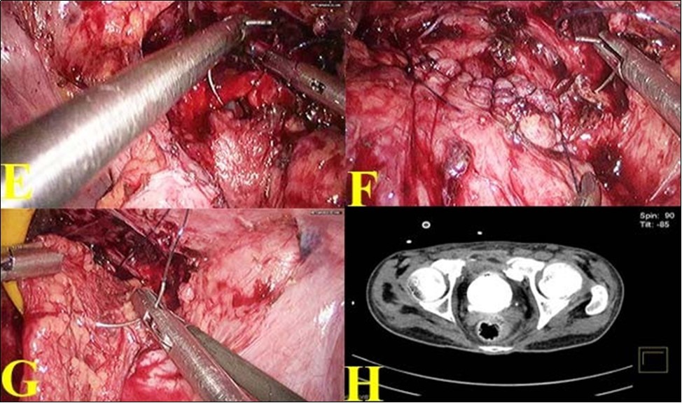 E. Bladder rent closing with barbed suture ; F. Suturing completed; G. Omental reinforcement over the suture line; H. Post operative CT showing healed bladder.