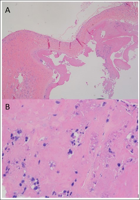 Representative photomicrographs of the fibrous capsule surrounding the left breast implant. A. Low power view showing the luminal side (bottom) is lined by fibrinoid material containing clusters of tumor cells. B. At high power, the tumor cells are large and pleomorphic; a small subset of cells has horseshoe-shaped nuclei consistent with hallmark cells (H&E stain; original magnification, x 40 A, x 400 B).