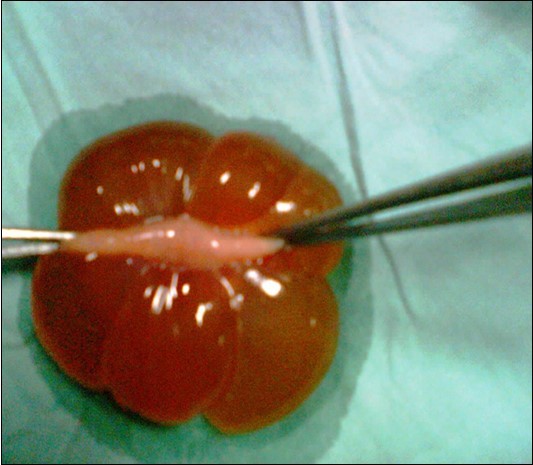 Fetal Abdominal Mesentric Lymphangioma along with part of jejunum.