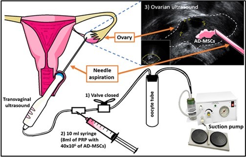 Technique; Application of PRP + AD-MSCs in the ovary; 1) The aspiration system is closed to prevent PRP + AD-MSCs from going to the oocyte collection tube; 2) PRP + AD-MSCs were injected with the flow of the system directed to the ovary, and 3) It is observed whether PRP + AD-MSCs are deposited in the ovary.