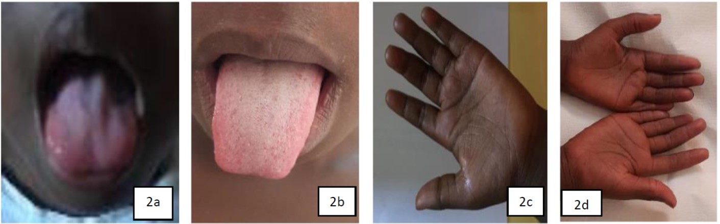 Hunter’s Glossite (2a); Disappearance of Hunter’s Glossitis (2b); Melanoderma (2c); Normal skin appearance after treatment (2d)