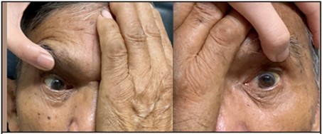 There was persistence of bilateral adduction deficit on duction testing