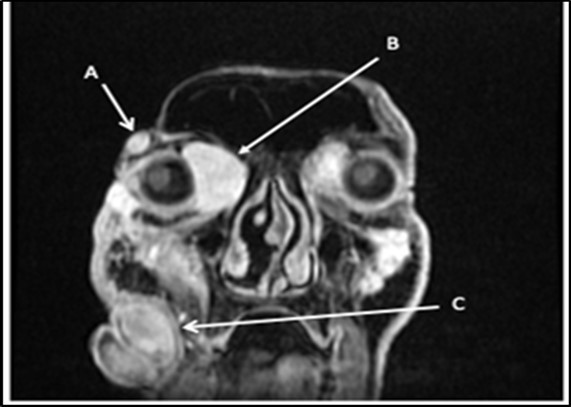 Multiple facial lesions radiologically consistent with neurofibromas. (A) 1.8X0.9X1.7cm right lateral temporal mass (B) 3.2X3X4.5 cmright medial intraorbital mass (B) (C) 8.6X7.3X6.0 cmr right nasal mass