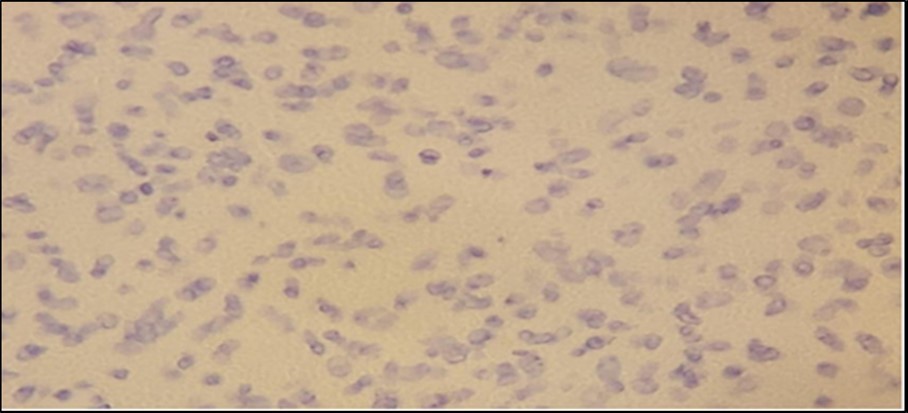 Immunohistochemistry Staining results. Smooth Muscle Actin (SMA) showed negative staining of cells.