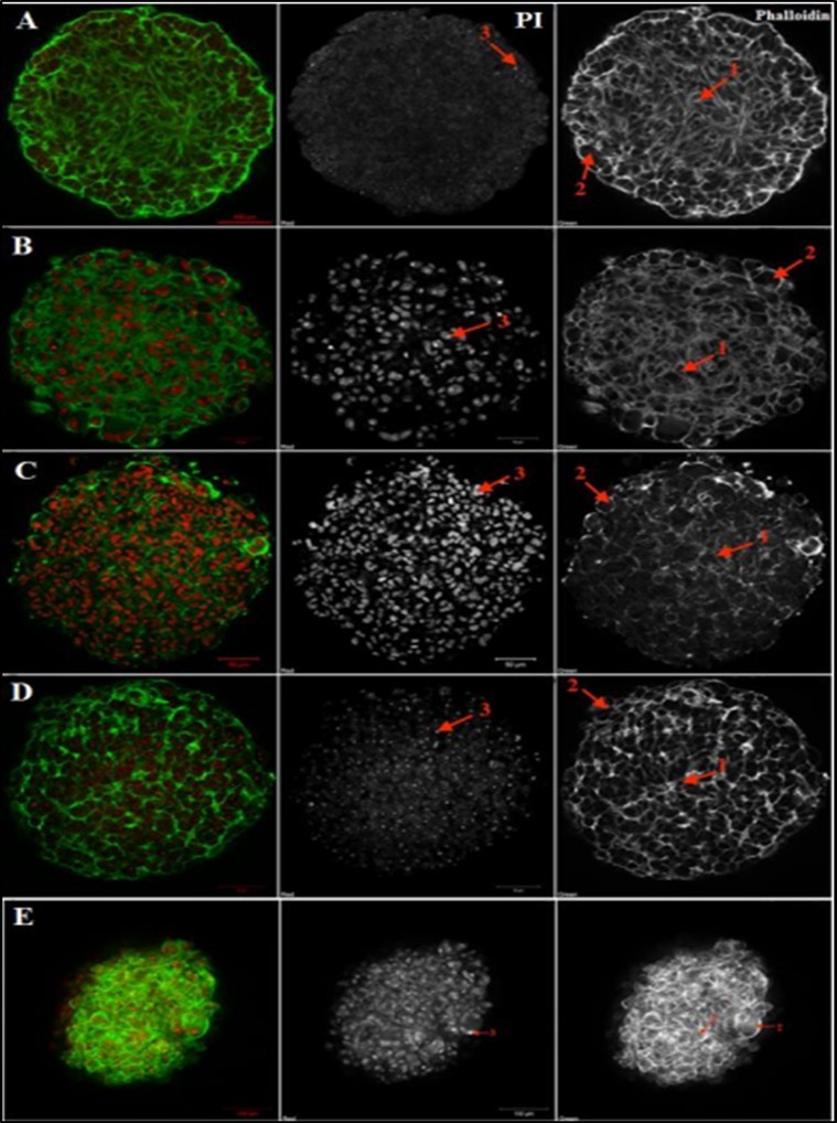 Confocal microscopy analysis of tumoroids’ structure A – melanoma cell culture #912, B – myxofibrosarcoma cell culture #728, C –leiomyosarcoma cell culture #699, D – melanoma cell culture #226, E – breast cancer cell culture #973. PI - Propidium iodide (red, nuclei), Phalloidin-Alexa-488 (green, F-actin). Legend: arrow 1 indicates inner spheroid layer and F-actin outgrowths, arrow 2 indicates proliferating rounded cells at the spheroid periphery, arrow 3 indicates stained nuclei. Scale bar is 50 µm for cell cultures #699, #728, #226, 100 µm for cell culture #912, #973.